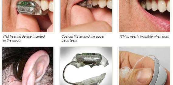 SoundBite prothese auditive dans les dents